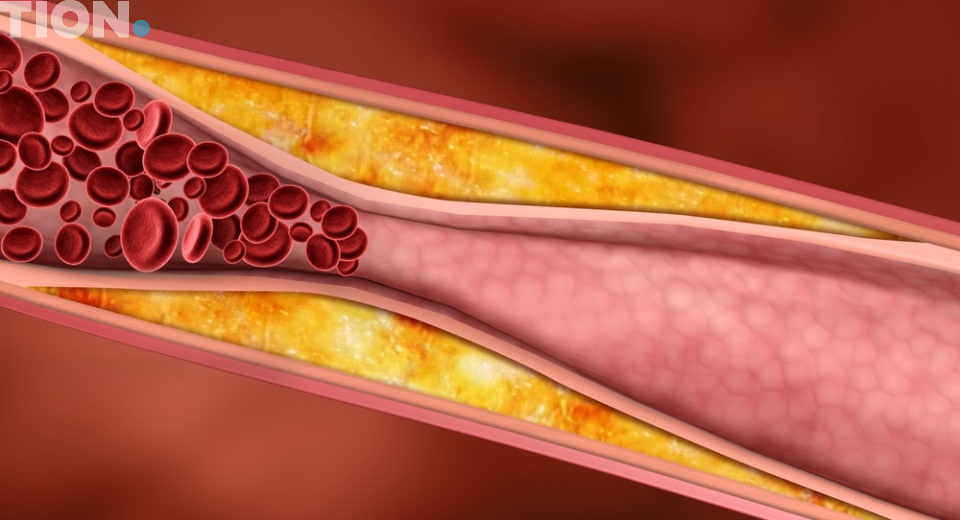 отрыв атеросклеротических бляшек